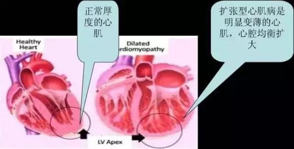 扩张性心肌病最新研究进展概述