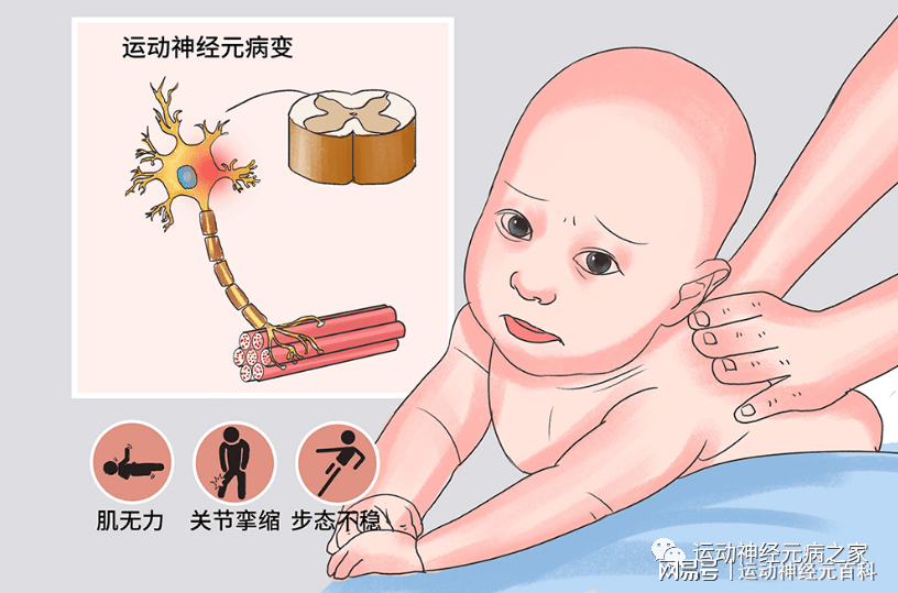 运动神经元病研究获突破，最新消息及未来治疗展望