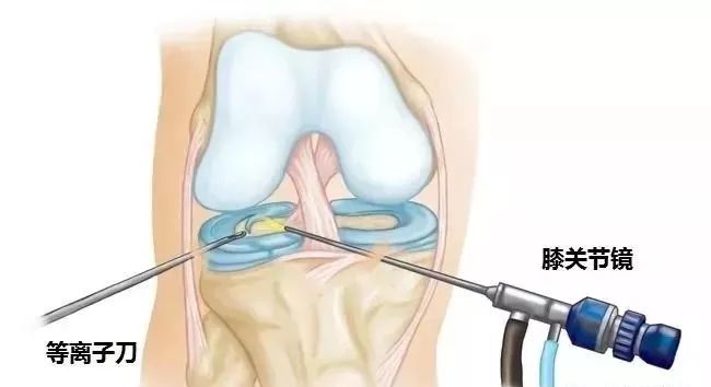 半月板再生术最新进展概览