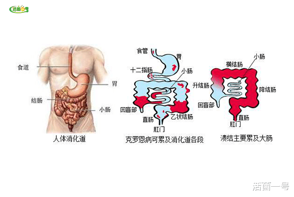 溃疡性结肠炎最新治疗策略解析