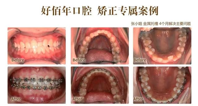 最新拔牙技术，革新口腔健康，引领未来新篇章